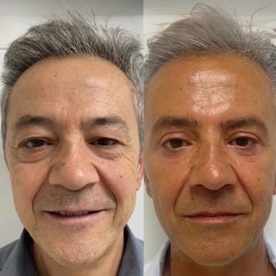 mediface-aesthetic-eyelid-surgery-in-turkey1.jpg