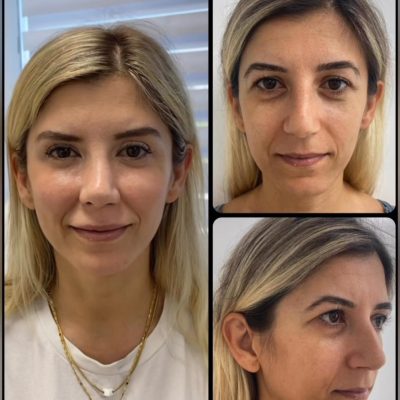 mediface-aesthetic-eyelid-surgery-in-turkey2.jpg