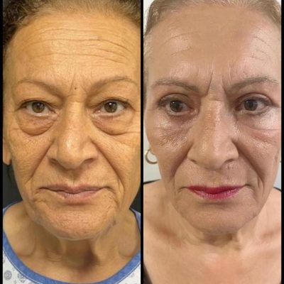 mediface-aesthetic-eyelid-surgery-in-turkey3.jpg