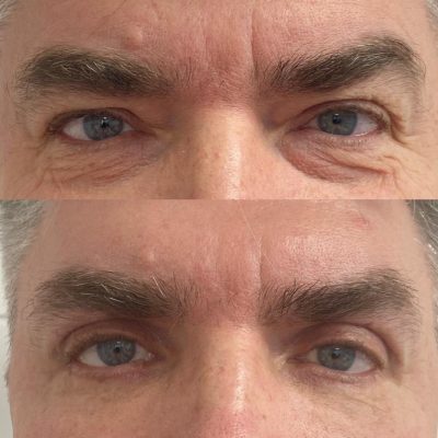 mediface-aesthetic-eyelid-surgery-in-turkey5.jpg