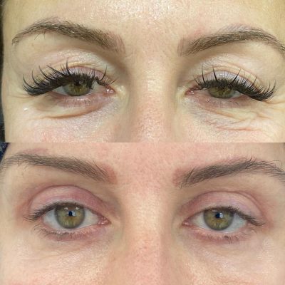 mediface-aesthetic-eyelid-surgery-in-turkey6.jpg