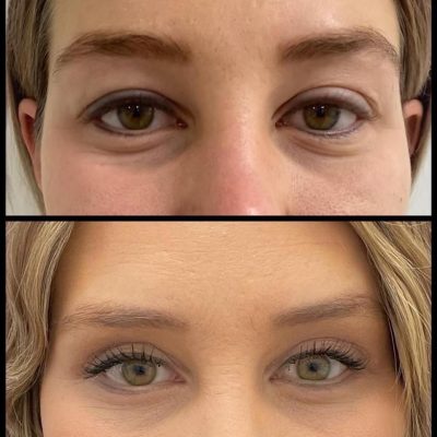 mediface-aesthetic-eyelid-surgery-in-turkey7.jpg